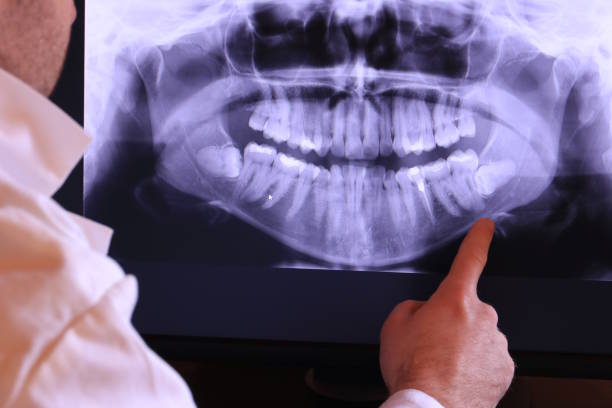 Best Emergency Wisdom Tooth Extraction in Ligh, NE